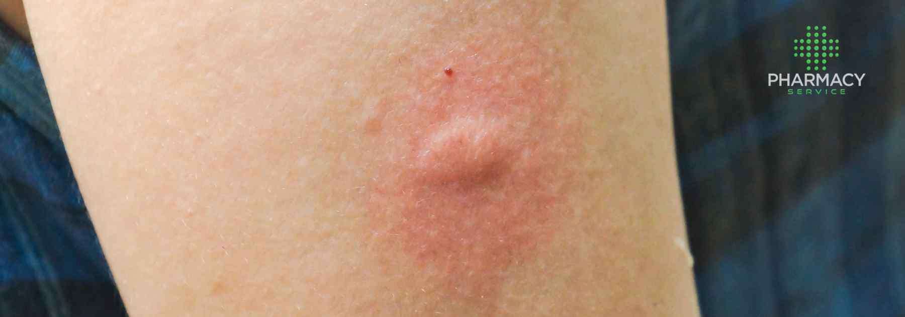 Infected insect bite treatment