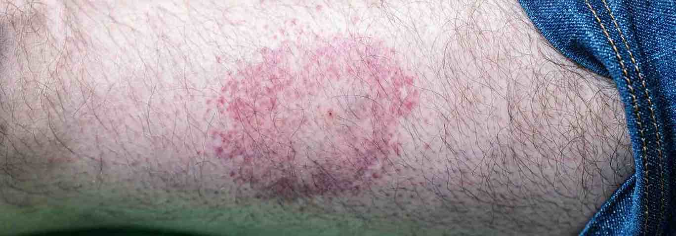 What does a tick bite look like?